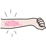 You’re Such an Itch: Eczema