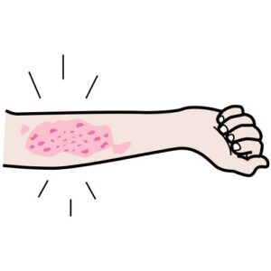 You’re Such an Itch: Eczema